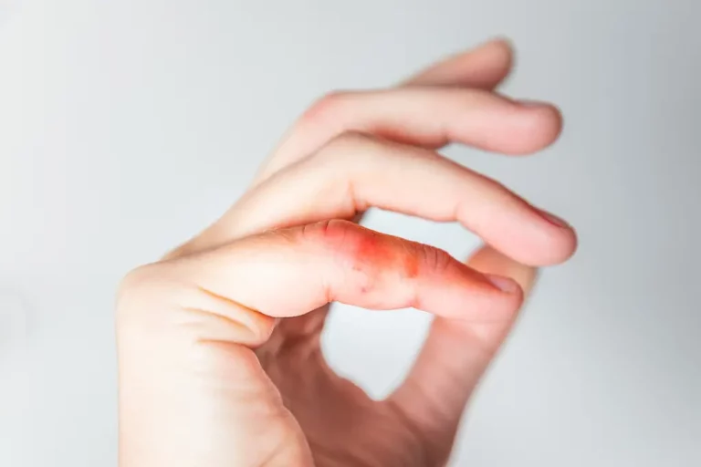 Sabañones: cómo prevenir esta reacción al frío
